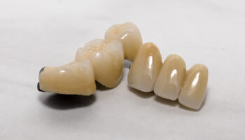 What To Do If Your Dental Crown Gets Damaged?