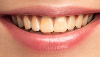 How Plaque Builds Up Over Time and Affects Your Oral Health — Tips from a Dentist Near You